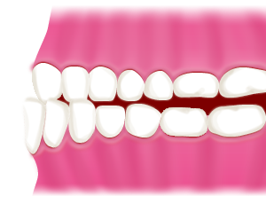 受け口(反対咬合)
